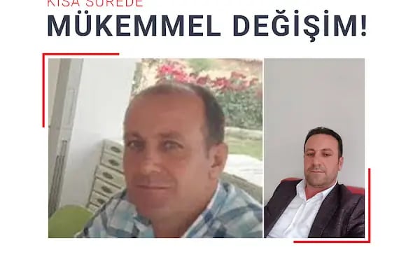 Fue Saç Ekimi Burak Karakaş - Resim 19
