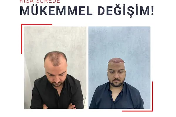 Fue Saç Ekimi Burak Karakaş - Resim 18