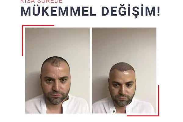Fue Saç Ekimi Burak Karakaş - Resim 12