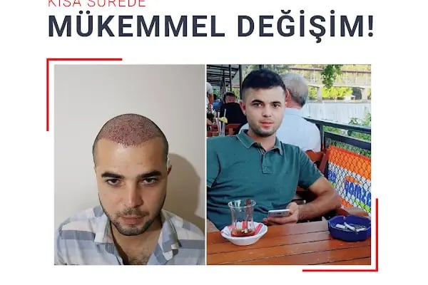 Fue Saç Ekimi Burak Karakaş - Resim 7