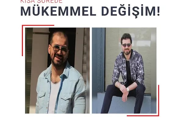 Fue Saç Ekimi Burak Karakaş - Resim 6