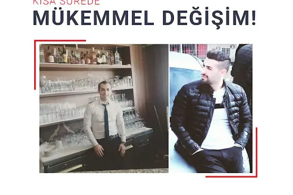 Fue Saç Ekimi Burak Karakaş - Resim 3