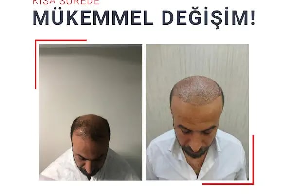 Fue Saç Ekimi Burak Karakaş - Resim 8
