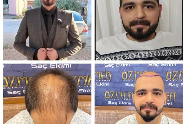 Özmen Saç Ekim , Estetik Ve Güzellik Merkezi - Resim 5