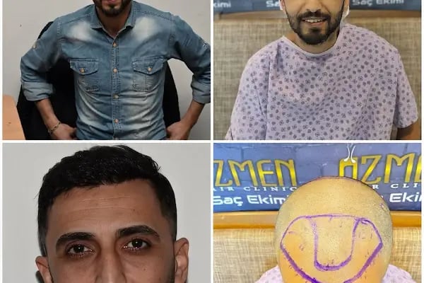 Özmen Saç Ekim , Estetik Ve Güzellik Merkezi - Resim 4