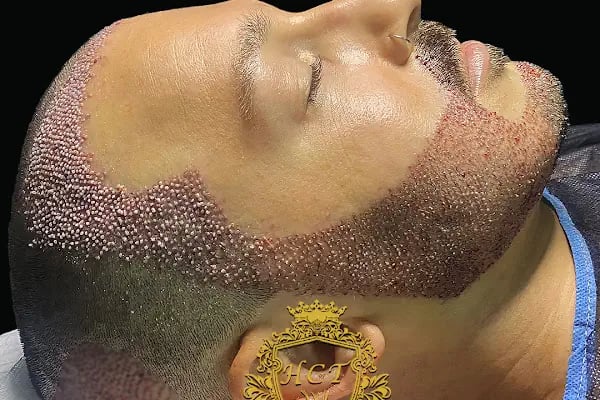 Hair Center of Turkey - Hair Transplant in Turkey, Istanbul - Resim 2