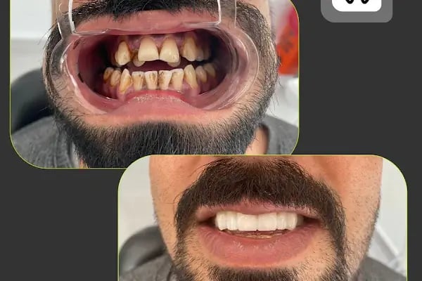 AKŞEHİR DENT MOON AĞIZ VE DİŞ SAĞLIĞI POLİKLİNİĞİ - Resim 16