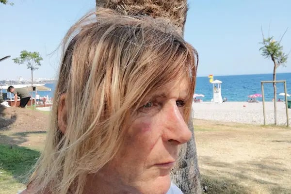 Op Dr Gökhan Özerdem, Estetik ve Plastik Cerrah Antalya - Resim 18