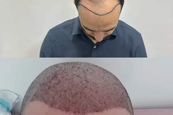 Haircenter Saç Ekim Merkezi - Resim 3