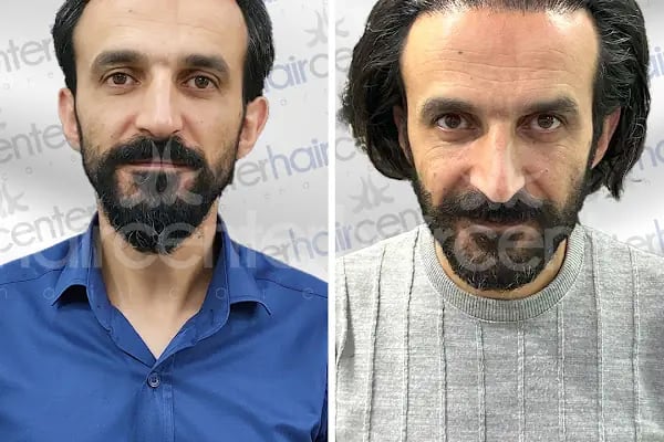 Haircenter Saç Ekim Merkezi - Resim 13
