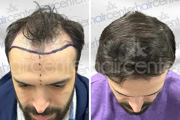 Haircenter Saç Ekim Merkezi - Resim 19