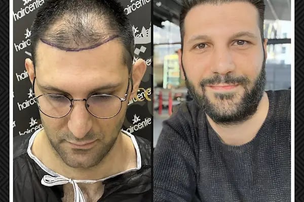 Haircenter Saç Ekim Merkezi - Resim 12