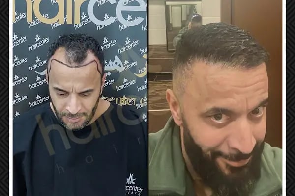 Haircenter Saç Ekim Merkezi - Resim 15
