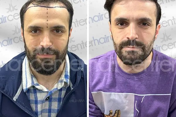 Haircenter Saç Ekim Merkezi - Resim 9