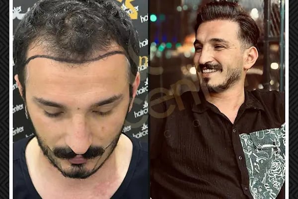 Haircenter Saç Ekim Merkezi - Resim 14