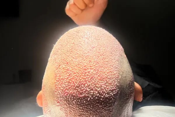 Haircenter Saç Ekim Merkezi - Resim 11