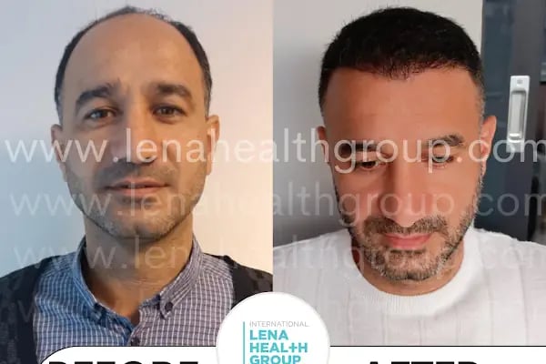 Lena Health Hairtransplant Turkey - Resim 1