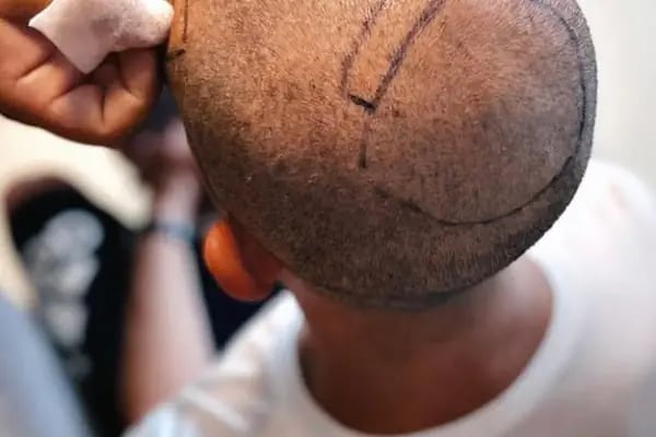 Lena Health Hairtransplant Turkey - Resim 17