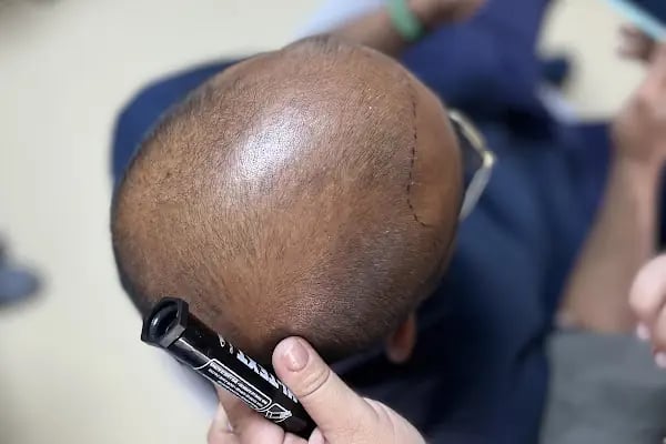 Lena Health Hairtransplant Turkey - Resim 18