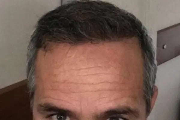 Trabzon Hair Transplant Center I مركز طرابزون لزراعة الشعر - Resim 9