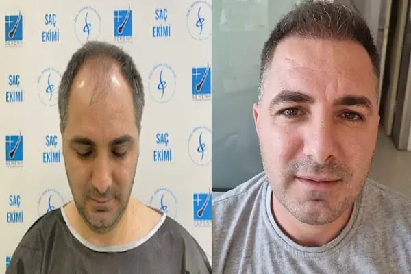 Likya Saç Ekim & Estetik | Alsancak - Resim 16