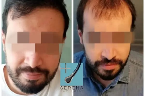 Likya Saç Ekim & Estetik | Alsancak - Resim 11