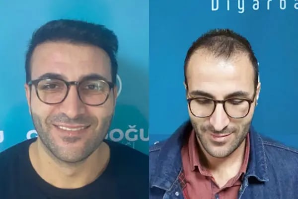 Güneydoğu Saç Ekimi - Resim 6