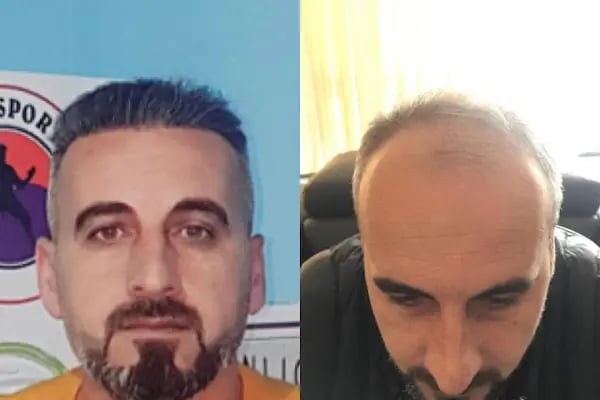 Güneydoğu Saç Ekimi - Resim 10