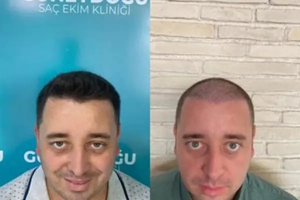 Güneydoğu Saç Ekimi - Resim 8