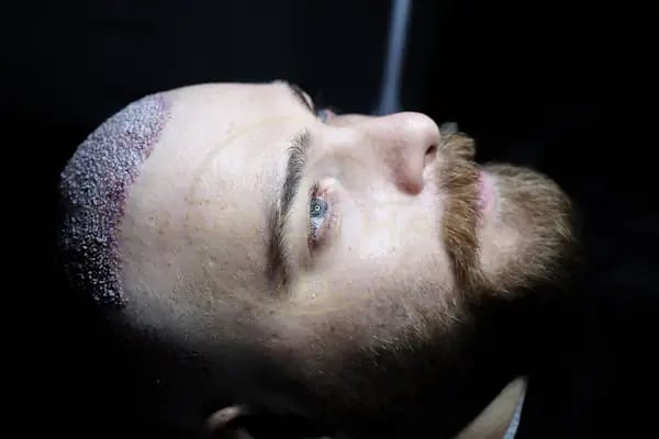 Land Of Hair - Hair Transplant Center / Istanbul Hair Transplant Center in Turkey - Resim 9
