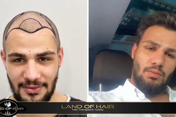 Land Of Hair - Hair Transplant Center / Istanbul Hair Transplant Center in Turkey - Resim 8