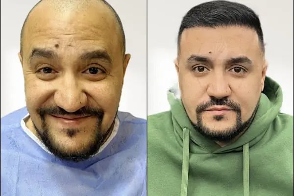 Land Of Hair - Hair Transplant Center / Istanbul Hair Transplant Center in Turkey - Resim 2