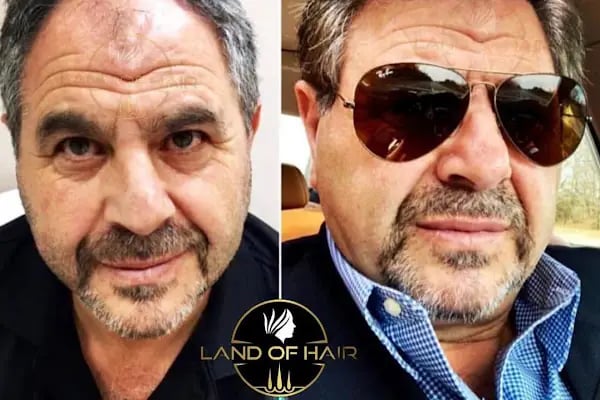 Land Of Hair - Hair Transplant Center / Istanbul Hair Transplant Center in Turkey - Resim 20