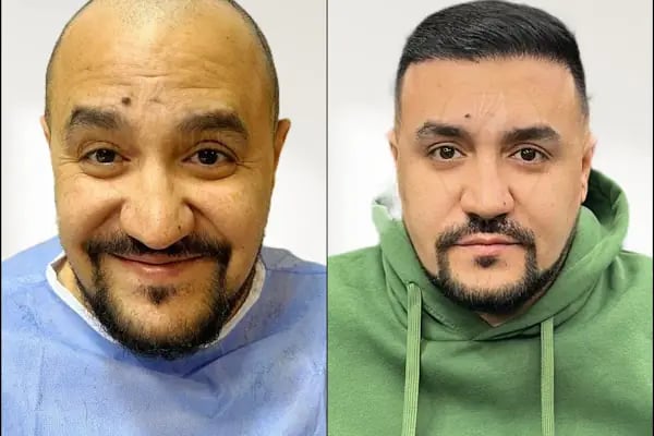 Land Of Hair - Hair Transplant Center / Istanbul Hair Transplant Center in Turkey - Resim 6