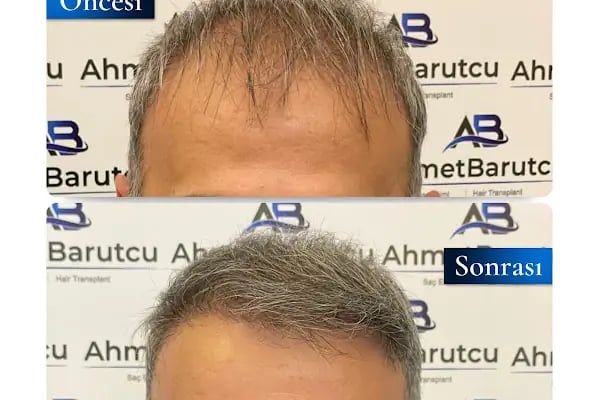 Ahmet Barutcu Saç Ekimi / Hair Transplant - Resim 7