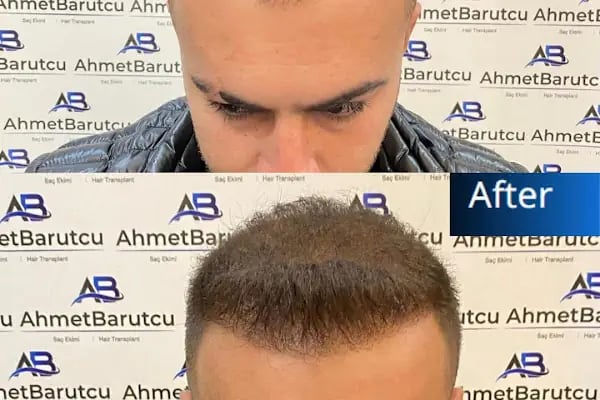 Ahmet Barutcu Saç Ekimi / Hair Transplant - Resim 11