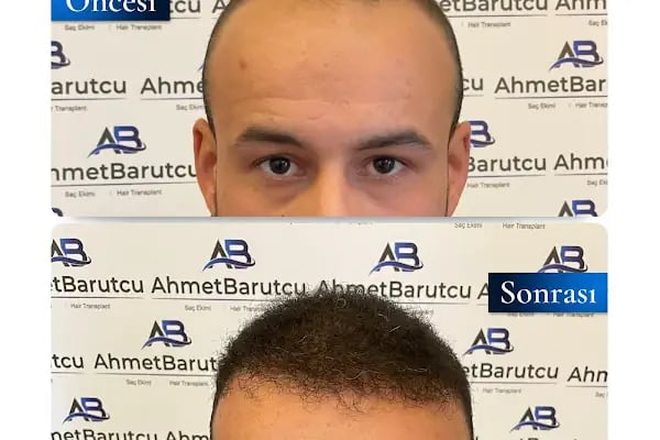 Ahmet Barutcu Saç Ekimi / Hair Transplant - Resim 13