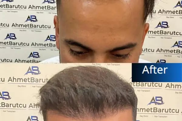 Ahmet Barutcu Saç Ekimi / Hair Transplant - Resim 4