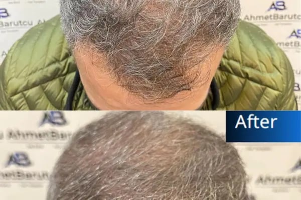 Ahmet Barutcu Saç Ekimi / Hair Transplant - Resim 3