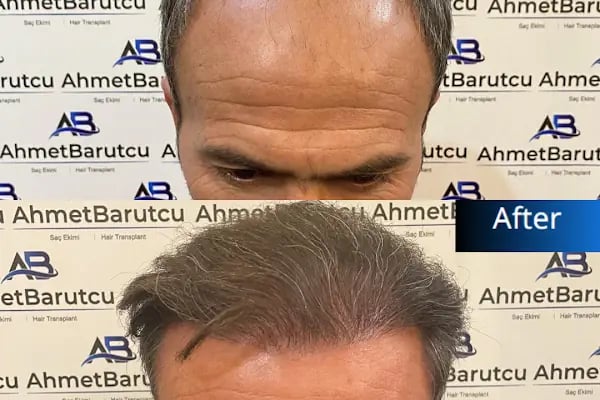 Ahmet Barutcu Saç Ekimi / Hair Transplant - Resim 14