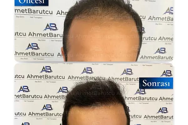 Ahmet Barutcu Saç Ekimi / Hair Transplant - Resim 18