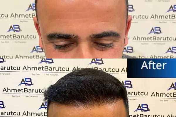 Ahmet Barutcu Saç Ekimi / Hair Transplant - Resim 12
