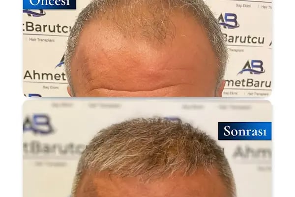 Ahmet Barutcu Saç Ekimi / Hair Transplant - Resim 15