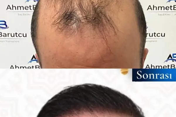 Ahmet Barutcu Saç Ekimi / Hair Transplant - Resim 10