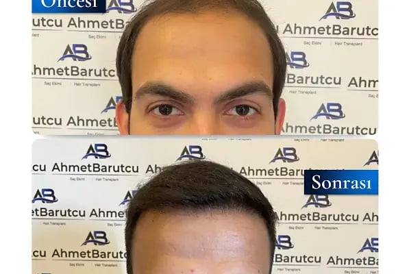 Ahmet Barutcu Saç Ekimi / Hair Transplant - Resim 9