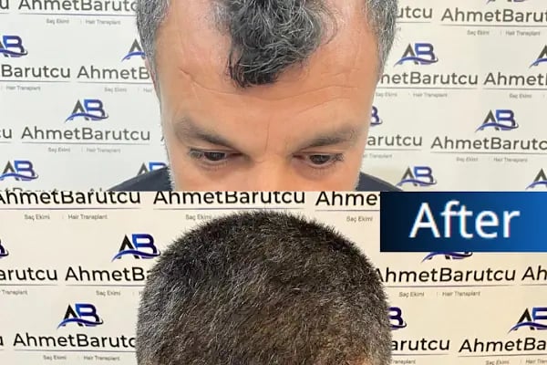 Ahmet Barutcu Saç Ekimi / Hair Transplant - Resim 17