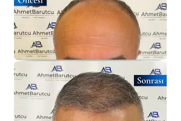 Ahmet Barutcu Saç Ekimi / Hair Transplant - Resim 5