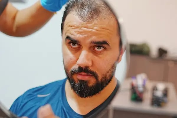 Real Of Hair - Hair Transplant Center in Turkey - Resim 19