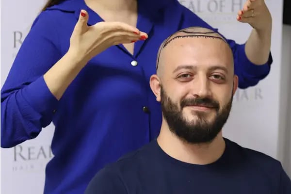 Real Of Hair - Hair Transplant Center in Turkey - Resim 15