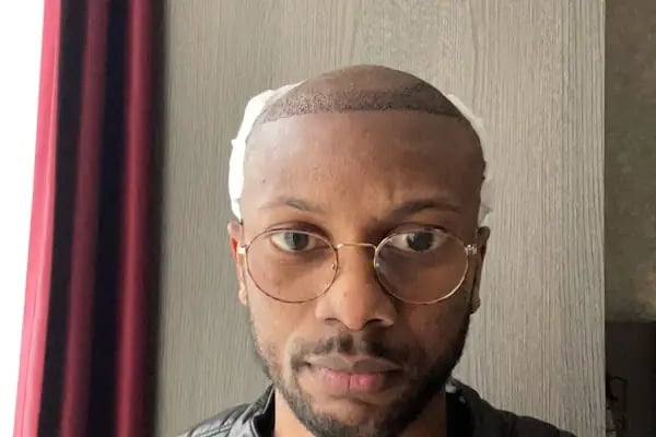 Dr.Gökeşme Hair Transplant - Resim 11